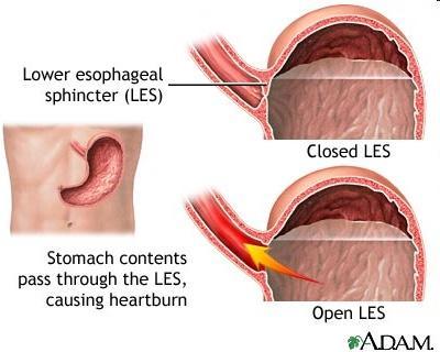 Digestive Tract: Stomach Lower esophageal sphincter: If the lower esophageal sphincter is not