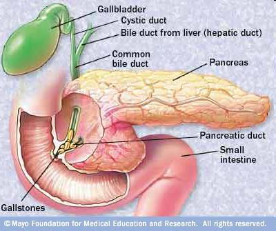 Digestive Tract: Duodenum, Pancreas, & Gall Bladder Gallstones: Crystallization of bile