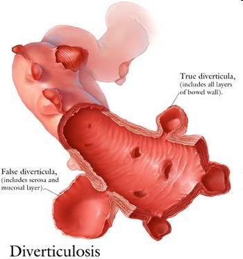 Digestive Tract: Large Intestines Diverticula: -Small pouches in the lining of colon,