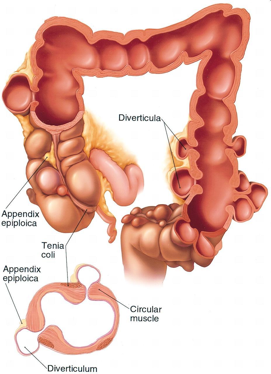Digestive Tract: Large Intestines Diverticulosis: -Caused by low fibre diet -Lack of exercise