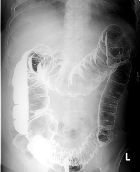 Digestive Tract: Large Intestines Diagnostic: Barium Enema Barium solution is inserted into rectum, to provide contrast for the