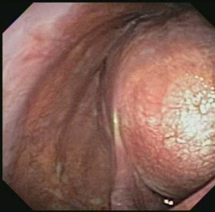 Fibrous tumor
