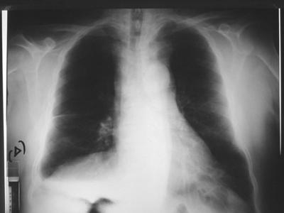 Figure 1 Figure 1ab: The patient's chest x-ray on admission.