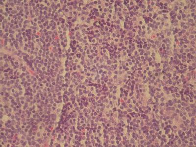 These findings, along with the presence of immunemediated thrombocytopenia and the persistence of the pleural effusion in the absence of a definite diagnosis led us to refer the patient for