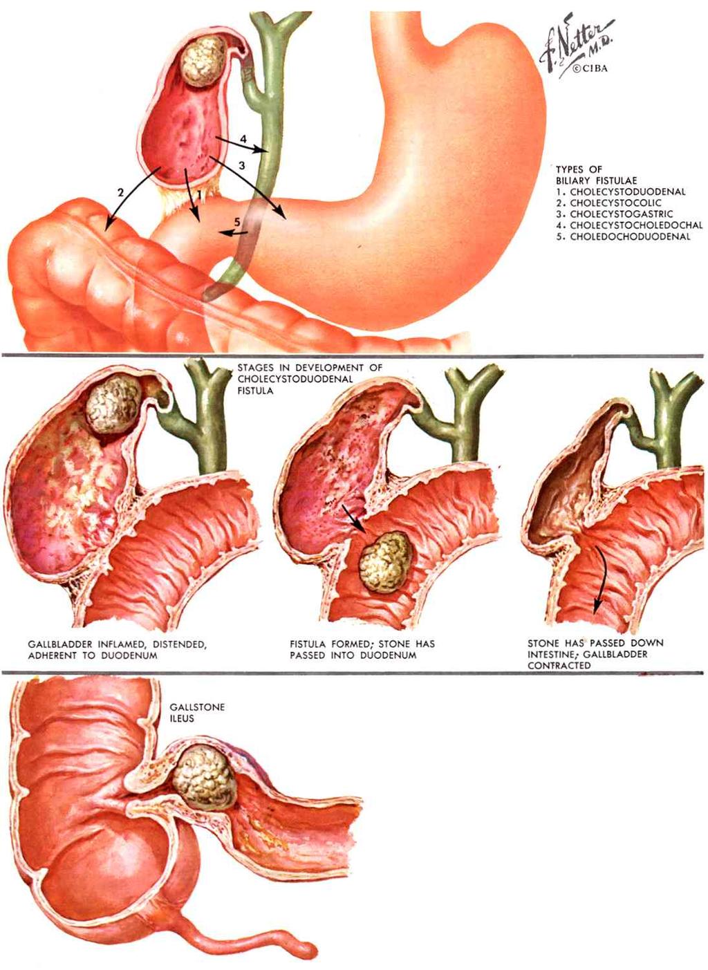 Biliary Fistulae May result from acute cholecystitis with obstruction of gall bladder neck, coupled with adhesions and abscess Potential fistulae with gall bladder: duodenum, transverse colon,
