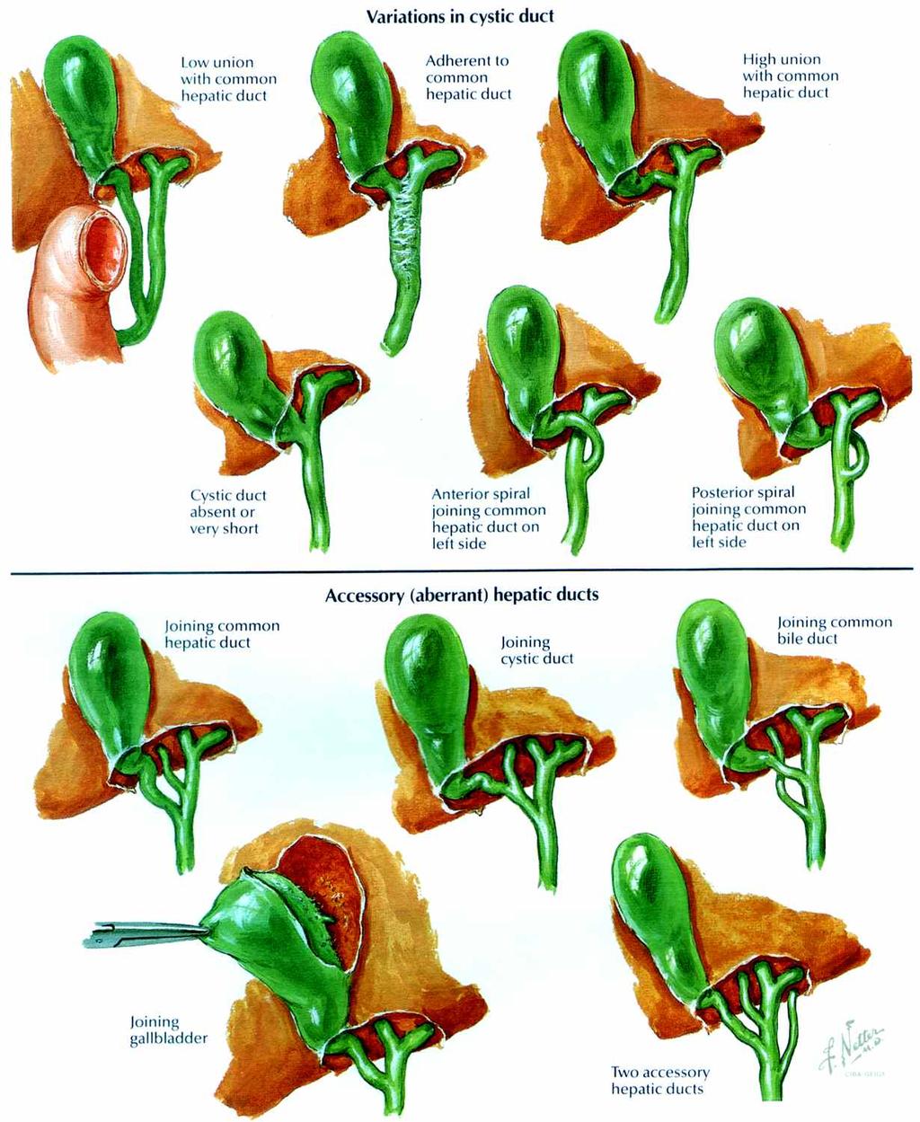 Extrahepatic Biliary Duct Variations Cystic duct length & origin Affects length of CHD, CBD, & size of Calot s triangle