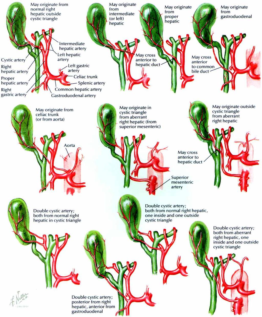 Cystic Artery Variations Arteries originating to the left of Calot s triangle usually cross the ducts anteriorly May originate from right hepatic, left