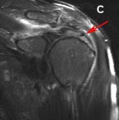 Case Studies The rotator cuff tear is identified as loose, degenerated, and frayed tissue around the cuff edge Pain