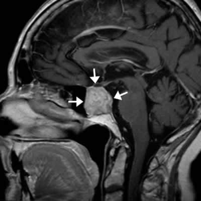 Case Studies Pituitary Tumour The Pituitary gland is a small endocrine/hormone gland which is located at the base of the brain.