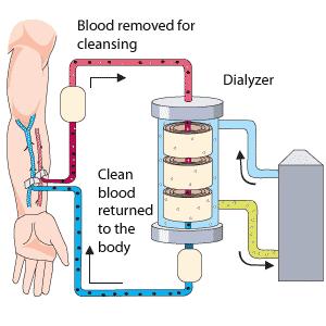 Treatment Dialysis (Hemodialysis, Peritoneal) Replaces function of dysfunctioning kidney Blood is passed through