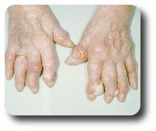 Crystals of uric acid sometimes collect in joints resulting in gout.