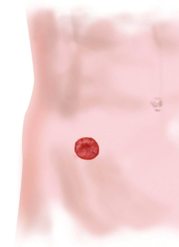 What Is a Urostomy? An ostomy is a surgically created opening in the abdomen for the discharge of body waste.