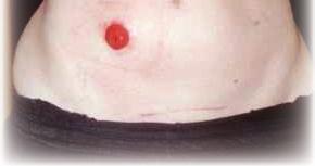 The stoma is the end of the small or large intestine that can be seen protruding or sticking out of the abdominal wall.
