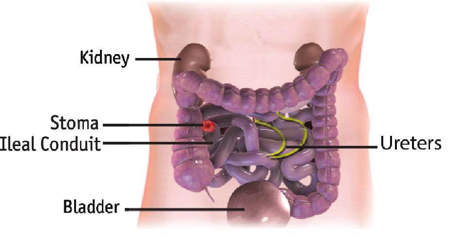 Urine is expelled or comes out when it passes from the bladder through the urethra. The creation of a urostomy changes how urine is emptied from the body.