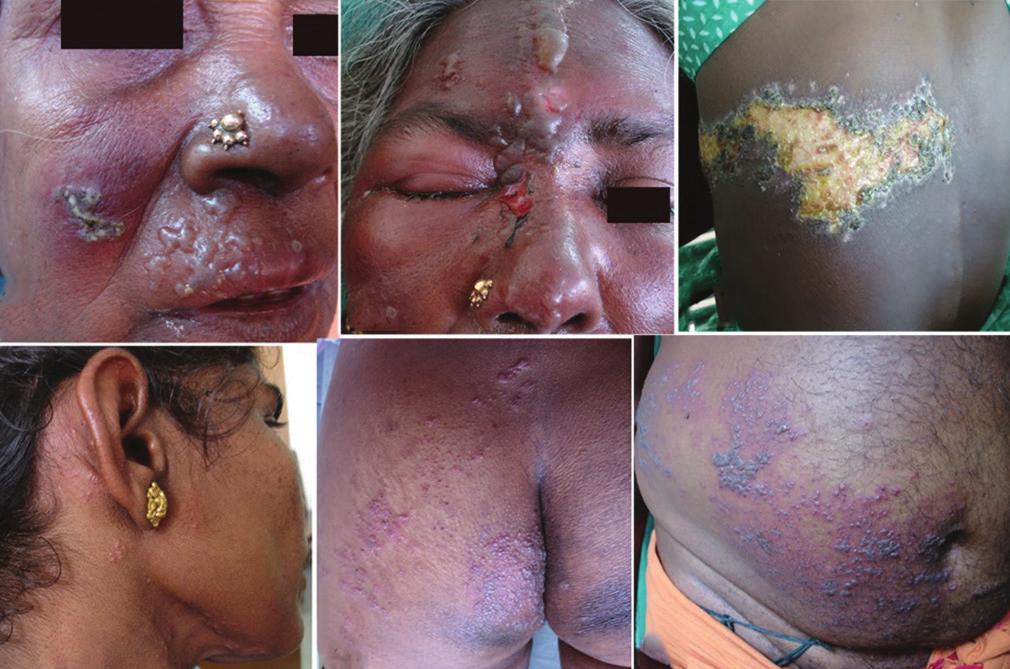 The remaining 3 (3%) cases had crusting and erosion in dermatomal pattern [Figure 1].