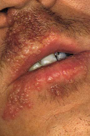 Herpes simplex clinical picture Primary lesion: HSV-1 children-asymptomatic gingivostomatitis drooling, fever, pain in mouth, edema, vesicles lymphadenopathy Recurrences: Herpes labialis