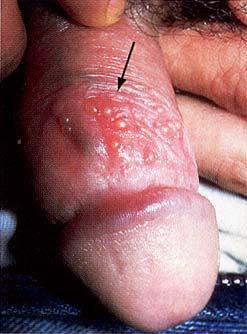Herpes simplex-2 Genital lesions symptoms from notable to debilitating modified by HSV-1 2-7