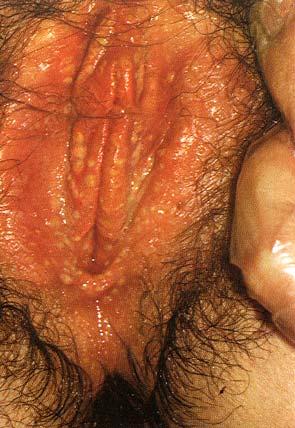 recurrences, 5-8/yr viral shedding between lesions! (importance?