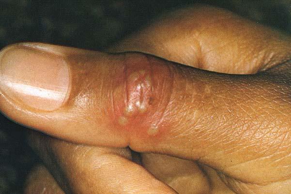 Other Herpes Manifestations Herpetic whitlow herpes fingers occupational hazard