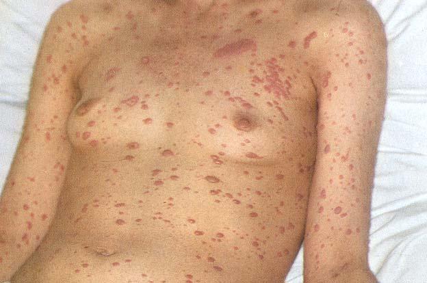 rich,crusty lesion viral poor Infections may be fatal