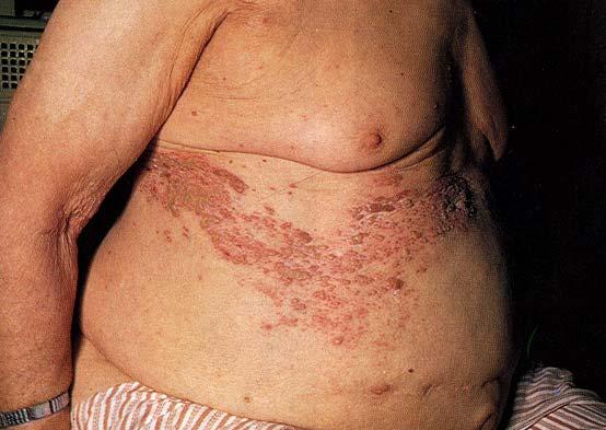 Pathogenesis of varicella/zoster Respiratory>viremia>skin Vesicles initially