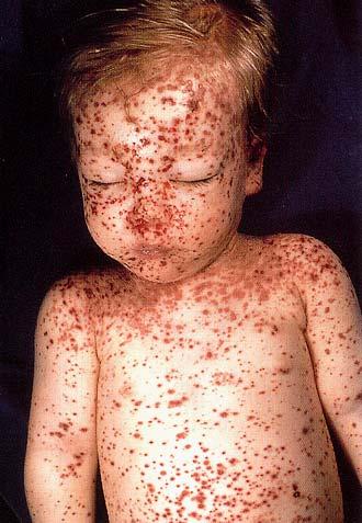 Clinical Picture Chickenpox: lesions: skin, mouth, vagina,