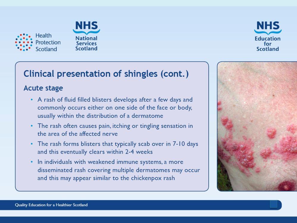 Slide 14 Shingles can affect any part of the body, although most commonly affected areas include face (including eyes) chest and abdomen.