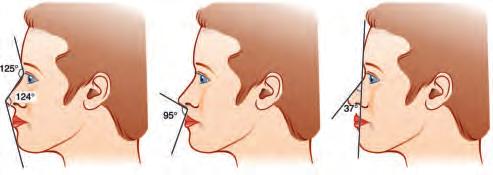 The facial plane should be visualised in profile and the projection of the nose in relation to forehead and chin analysed. The malar arch projection should be assessed.