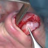 The various techniques which help us to execute each of the above four steps with sutures and cartilage cutting manoeuvres are outlined: Step 1: Cephalic Rim Strip Excision of the cephalic border not