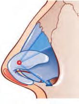 Aims of Septoplasty Straight, midline nasal septum. Maintain dorsal and tip support.