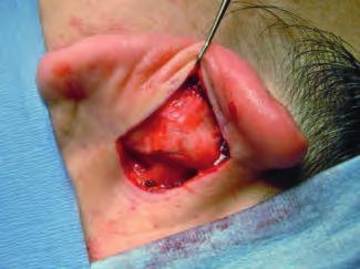 Nasal septal cartilage is readily accessible, and if undamaged, offers suitable tensile strength for septal and columella strut grafts, but may not provide enough volume for adequate dorsal