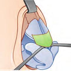 The spreader graft is an internal spacer graft of cartilage up to 2 mm wide positioned between the dorsal septum and the upper lateral at its dorsal edge.