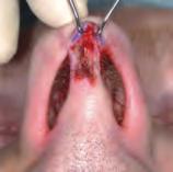Achieve extension of the above incision into marginal incisions at the correct level avoiding trauma to the alar rim and lower lateral cartilage.