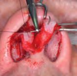 Reduce tip volume by cephalic trim of lateral crus of the alar cartilages. To decrease the projection increase cephalic rotation with lateral crural overlap.