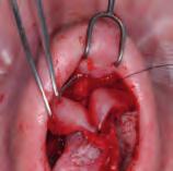 Open Structure Rhinoplasty A Manual of Surgical Skills Training 45 a b c 54 Lateral crural flare control suture.