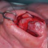 The suture should be placed in the lateral crus at the level of the alar ballooning as far laterally as possible, starting