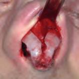 border through an open approach. Remove any overlying scar tissue.
