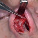 46 Open Structure Rhinoplasty A Manual of Surgical Skills Training a 56 Lateral crural overlap.