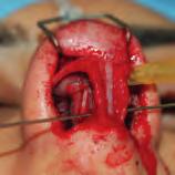 Open Structure Rhinoplasty A Manual of Surgical Skills Training 51 Exercise 9 Tip Grafts S. Sheikh Educational Aims Fashion a shield graft from septal cartilage and perform tip grafting.