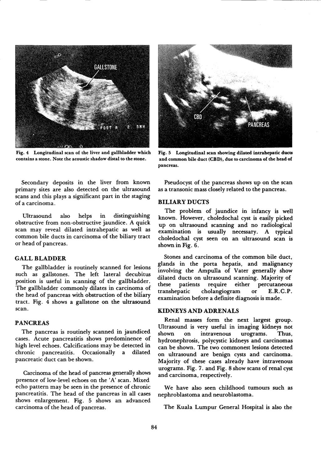 Fig. 4 Longitudinal scan of the liver and gallbladder which contains a stone. Note the acoustic shadow distal to the stone. Fig.
