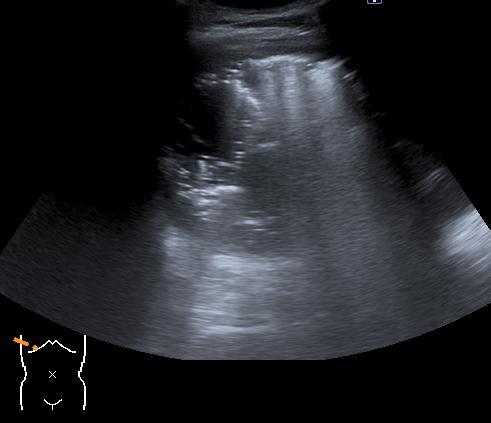 Liver abscess Pyogenic liver abscess Frankly purulent: cystic, with the fluid ranging from echo free to highly echogenic Early suppuration: solid with altered echogenicity,