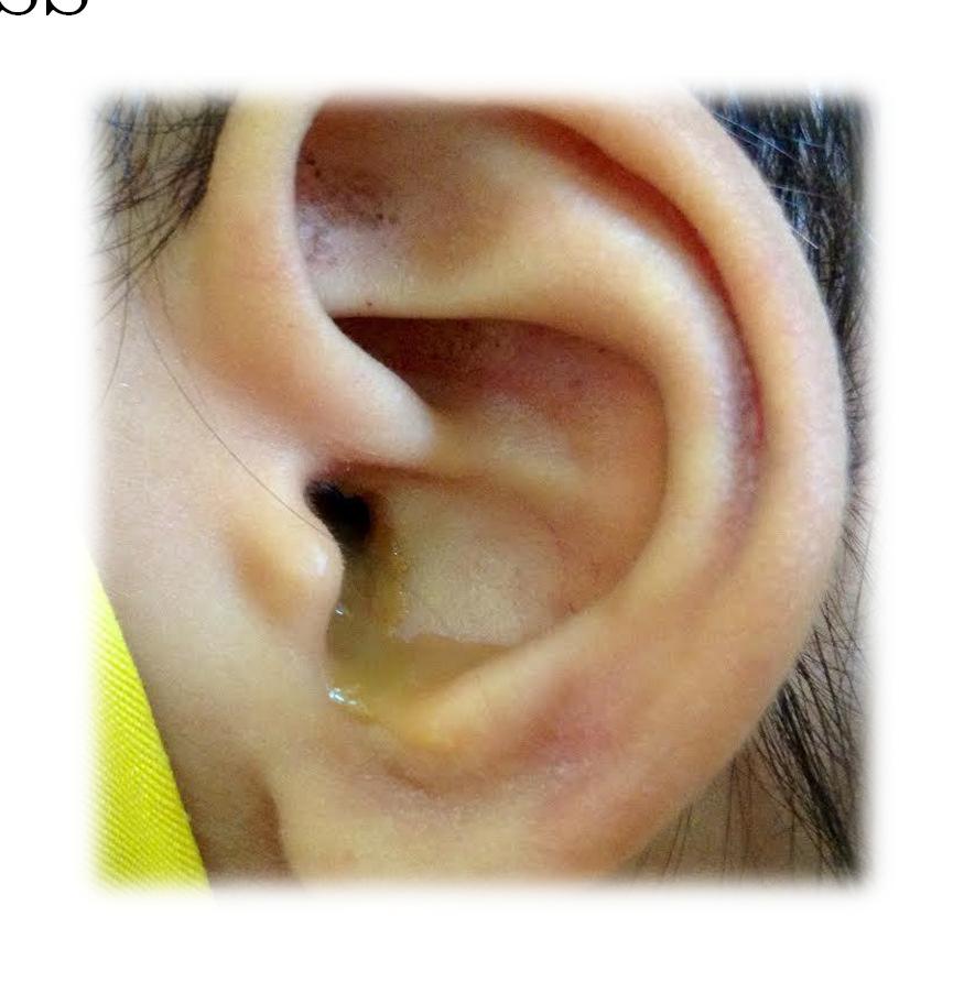 EAR DISEASES THAT CAN LEAD TO HEARING LOSS