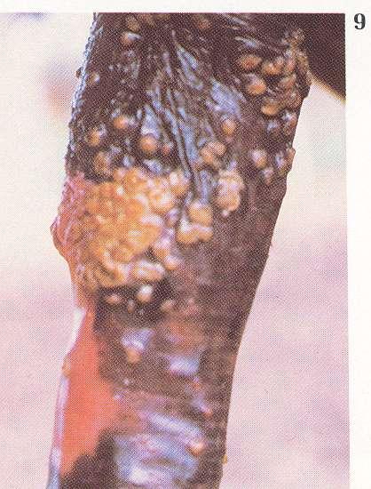 primary lesions Pustule: a vesicle filled with pus (inflammatory cells). These lesions are seen in staph. and strept.