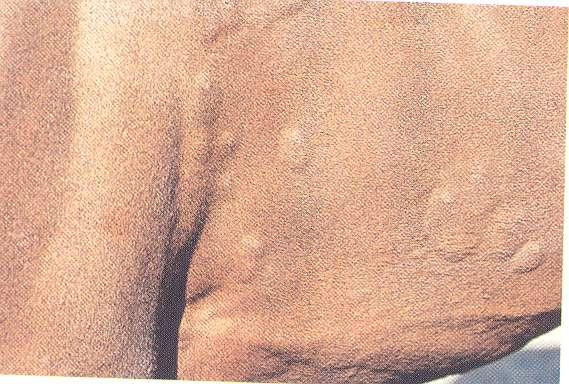 6-Urticaria allergic condition characterized by the appearance of