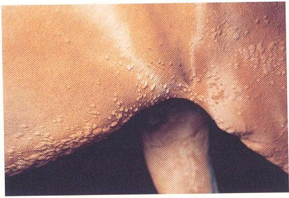 Conventional wheals lesions are 2-3 mm up to3-5 cm