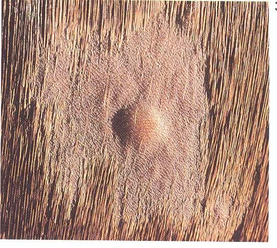 primary lesions Papule: a circumscribed, palpable solid usually round mass in the skin, less than 1cm.