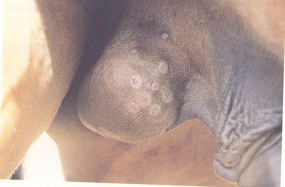 dermatitis Viral papular dermatitis lesions on the