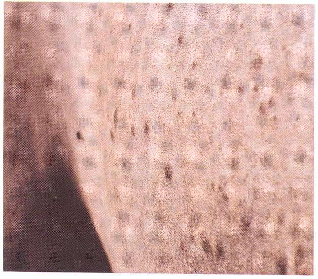 primary lesions Nodule: a circumscribed, solid, usually round mass, usually raised and rounded more than 1cm.