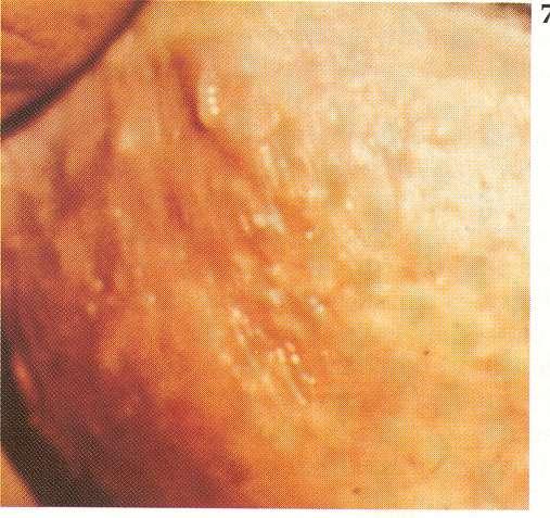 primary lesions Vesicle: a circumscribed, elevated, fluctuant fluid filled lesion containing serum, (1cm).