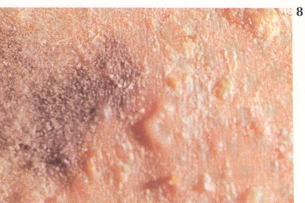 primary lesions Bulla: a vesicle more than 1cm. They can be epidermal or subepidermal.